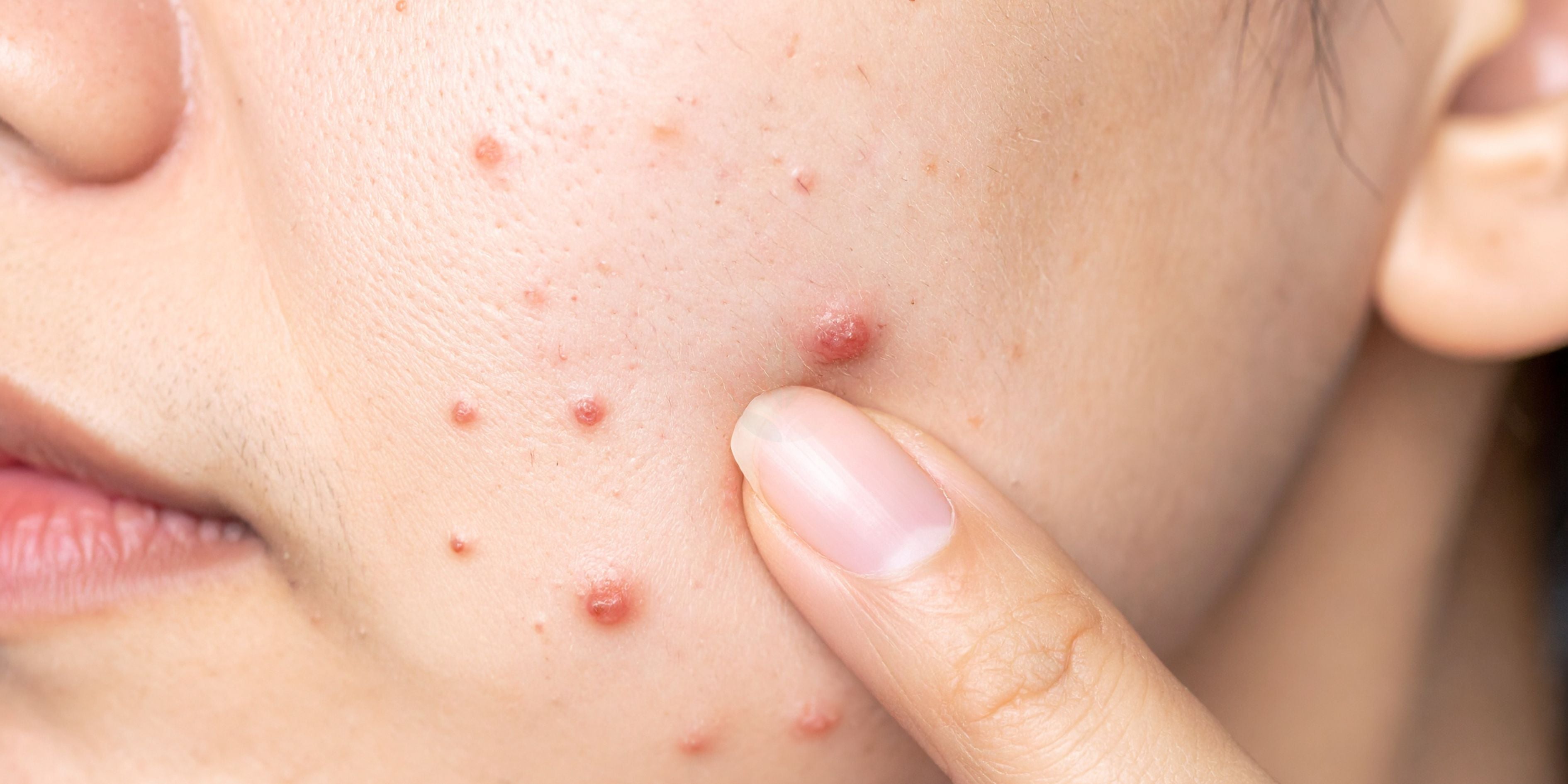 Acné e imperfecciones