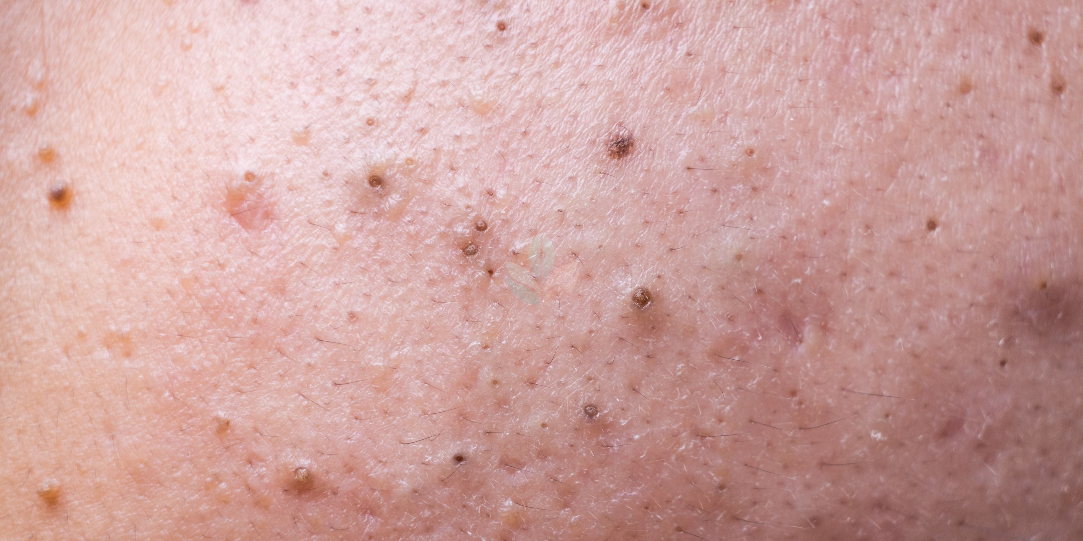 Limpieza profunda y poros